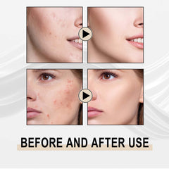 Lactose Solution, Exfoliate Remove Blackheads Shrink Pores Clean And Moisturize SkinEssence