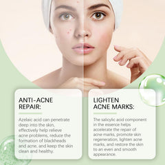 Azelaic Acid Facial Essence Moisturizes And Improves The Skin For Blackheads And Acne