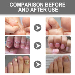 Nail Care Cream, Light Armor Repair Bad Ingrown Nail Nails Brothers Nail Thickening A Ditch Nursing