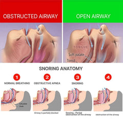 Anti-Snoring Braces Anti-Snoring, Anti-Grinding, Anti-Breathing Mouth Guard Anti-Snoring Dental Support Protective Braces