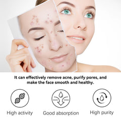 Herbal Acne Serum, Reduce Acne Pimples With A Comprehensive Moisturizing Moisturizer