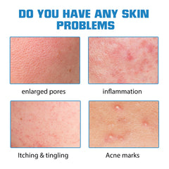 Hyaluronic Acid Face Serum, Moisturizing Repair Lighten Acne Mark Skin Care Whitening Essence