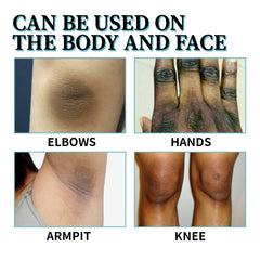 Acanthosis Nigricans Therapy Lotion, Skin Moisturizing Clean Black Dark Heavy Alar Knee Joint Repair Carry Bright Color Of Skin