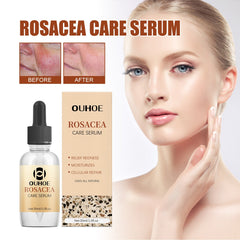 Erythematous Repair Essence, Repair Skin Lighten Facial Erythematous Moisturizing Essential Oil