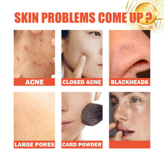 Snail Nourishing Repair Essence, Lightening Acne Muscle Acne Mark, Hydrating Whitening And Eliminate Pimples Essence