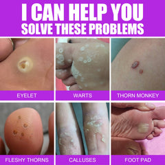 Remove Chicken Eye Lotion Extra Clear Remove Corns Skin Care Chicken Calluses Foot Pad Gram Warts