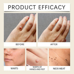 Mole And Wart Care Cream, Soft And Smooth Skin Moisturizing And Repairing Skin Care Cream