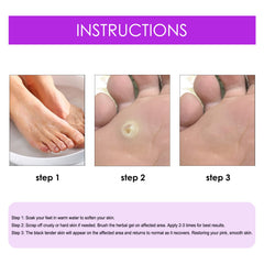 Remove Chicken Eye Lotion Extra Clear Remove Corns Skin Care Chicken Calluses Foot Pad Gram Warts