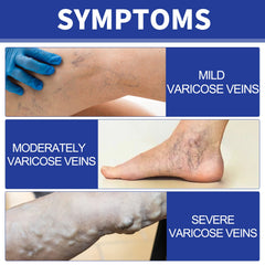 Vein Comfort Spray, Relief Leg Muscle Soreness And Swelling Earthworm Leg Vein Treatment Spray