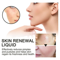 Skin Renewal Liquid, Reduce Acne Print Repair Acne Muscle Mild Clear Acne Hydrating Essence