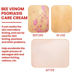 Bee-Poison Cowhide Moss Cream, Which Relieves Redness And Itchiness Of Skin